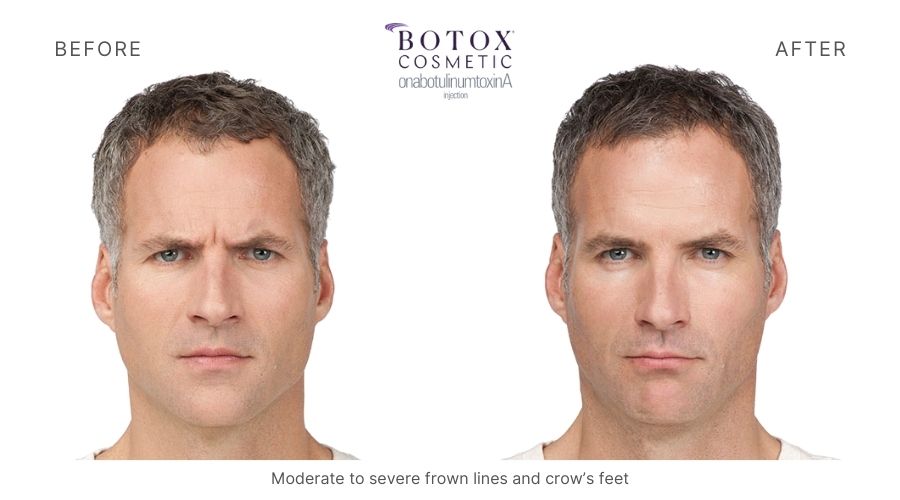 Botox before and after, eliminating moderate to severe frown lines and the crow's feet of a man.