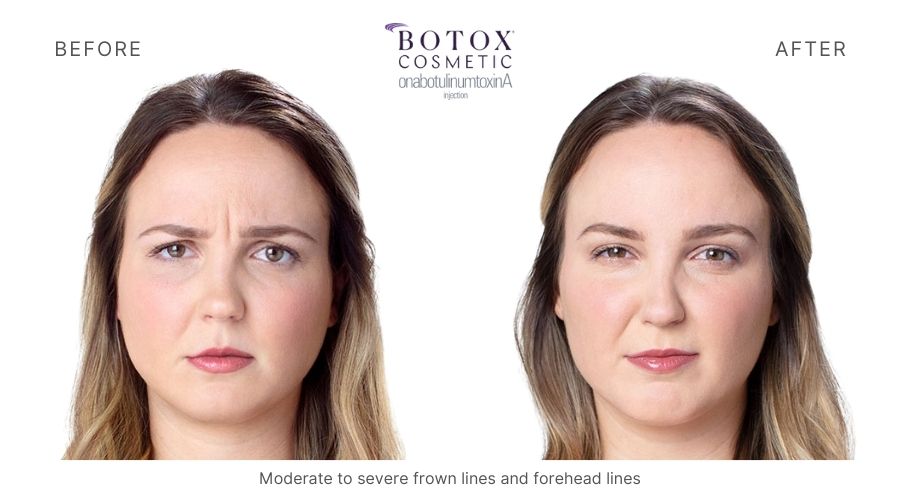 Botox before and after, eliminating moderate to severe frown lines and forehead lines in a woman.